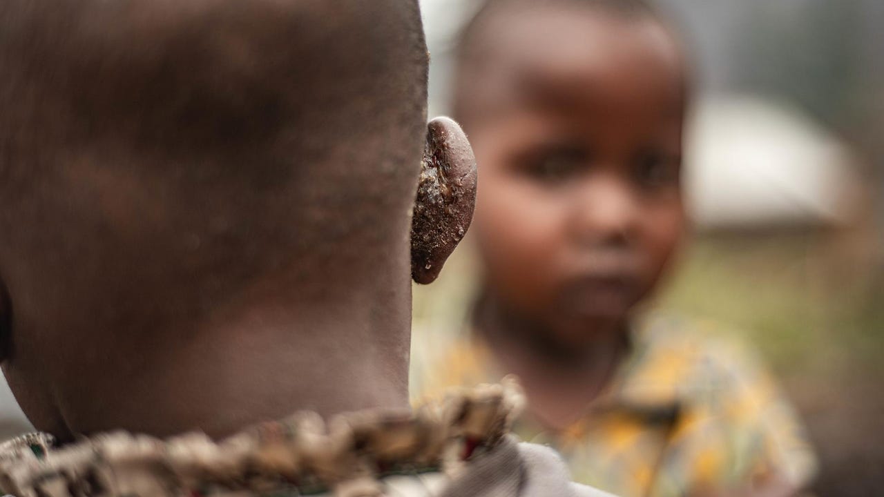“Concern” for cases in Sierra Leone