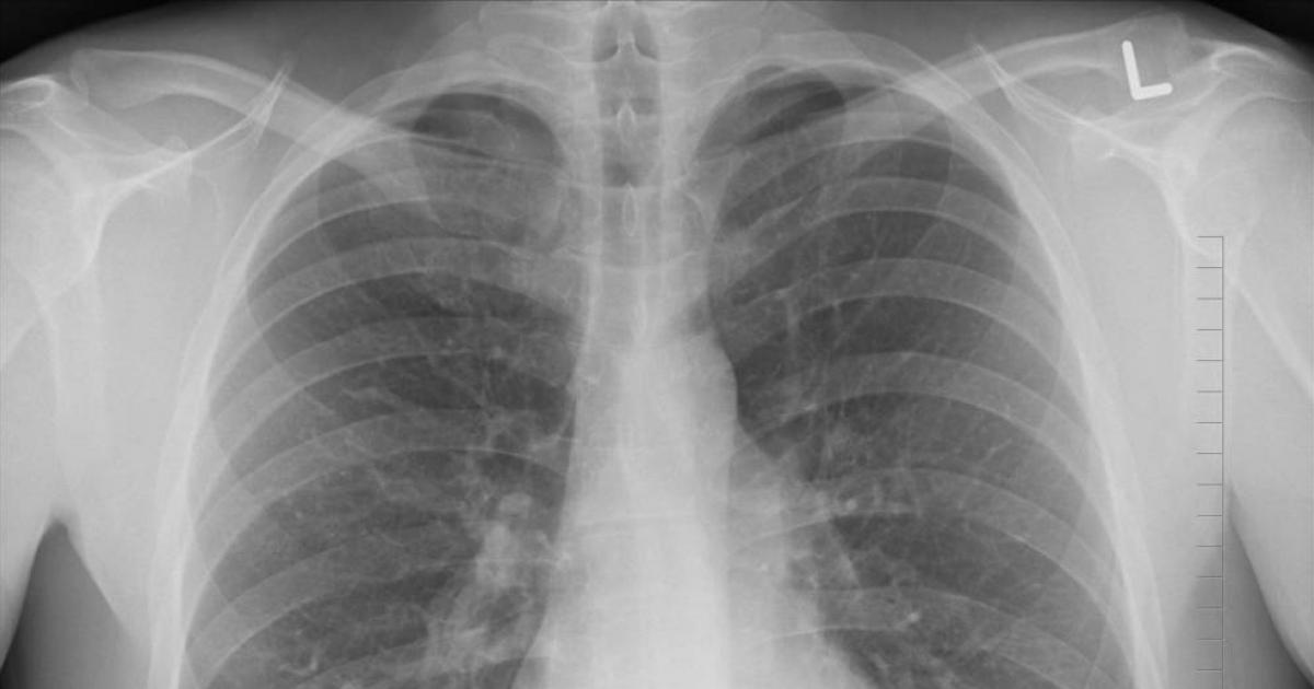 A study reveals what the cause of lung cancer in non -smoking people can be