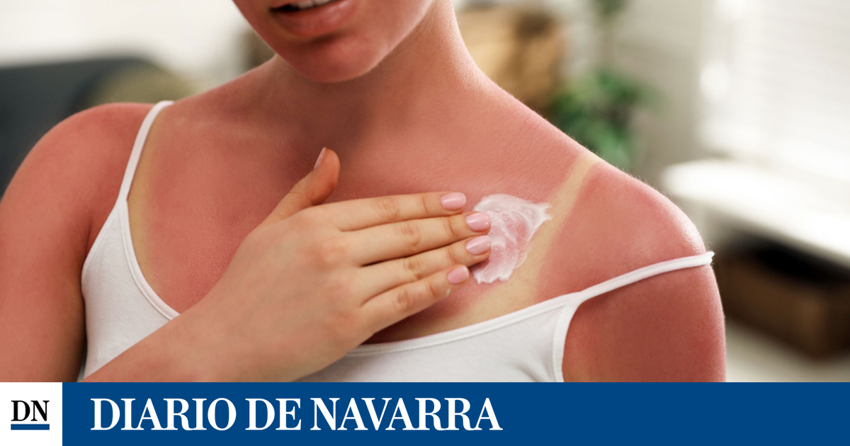 Have you sunbathe and burn yourself? These are the advice of the University of Navarra Clinic to relieve symptoms Have you sunbathe and burn yourself? These are the advice of the University of Navarra Clinic to relieve symptoms